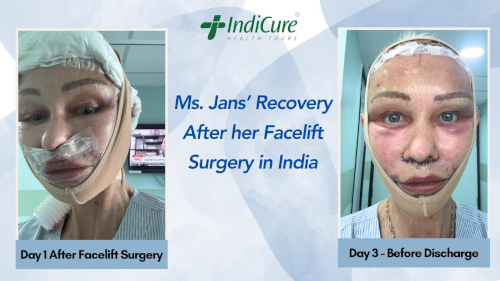 Recovery After Facelift Surgery in India